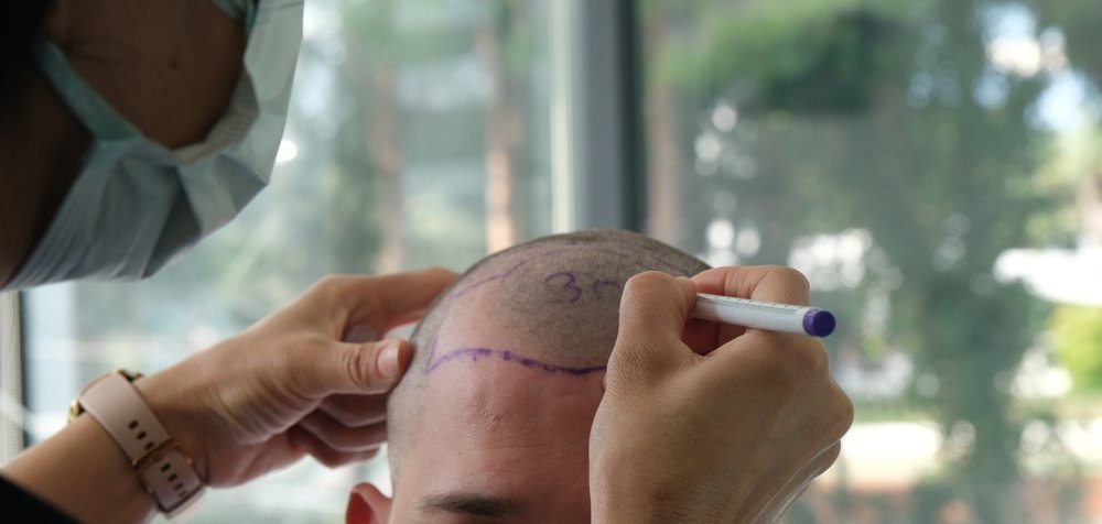 Hair Transplant: Important Factors To Know Before Undergoing