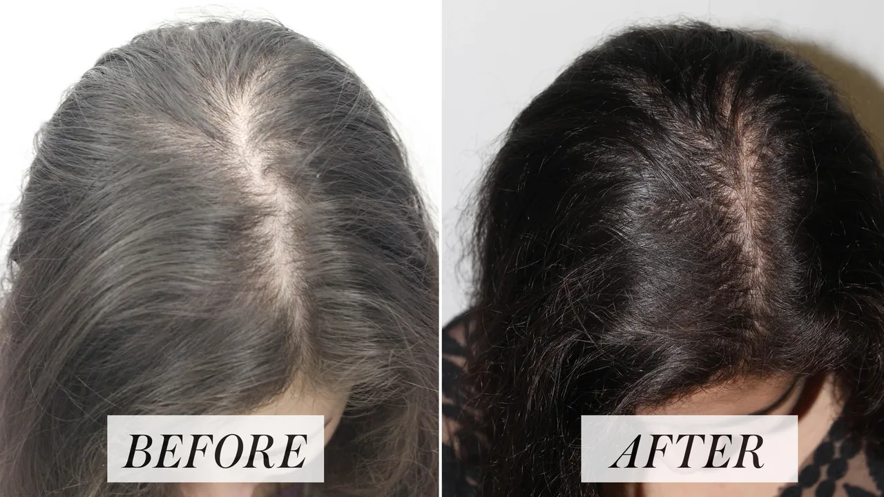 Is Hair Restoration The Most Effective Hair Loss Treatment?