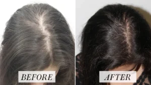 ¿Es la restauración capilar el tratamiento más efectivo para la pérdida de cabello?