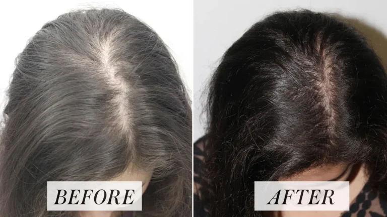 ¿Es la restauración capilar el tratamiento más efectivo para la pérdida de cabello?