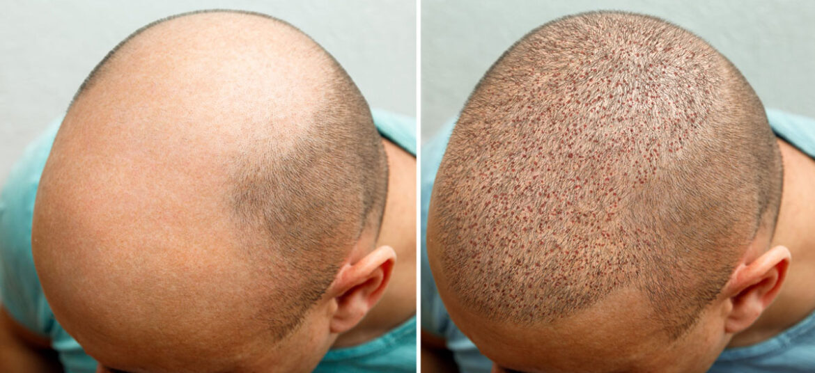 How To Enhance The Hair Growth Rate After Hair Transplant Surgery?